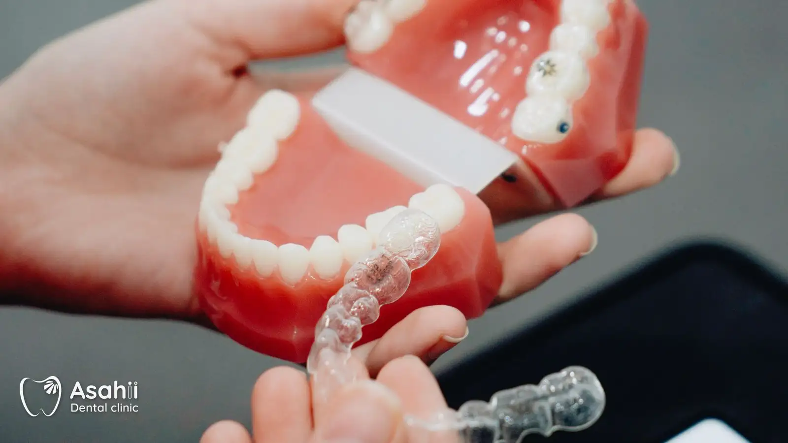 Mắc cài hay khay trong suốt: mỗi cách hợp với những ca và thói quen khác nhau