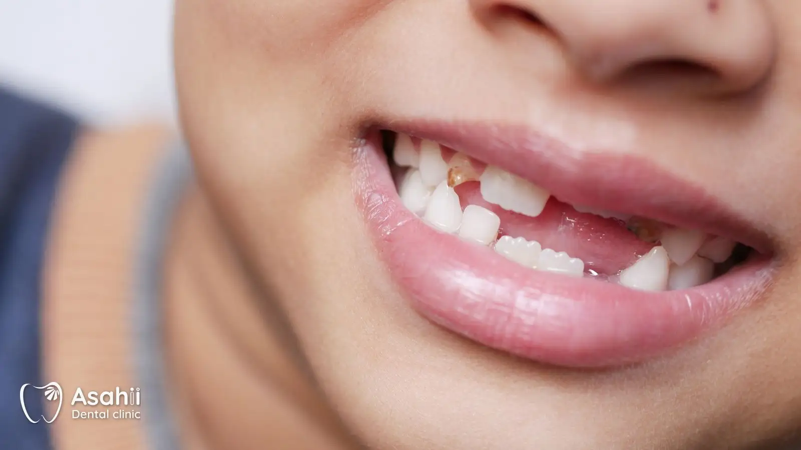 Răng sữa mất sớm để lại khoảng trống mà răng bên cạnh có thể nghiêng vào, lấn chỗ răng vĩnh viễn