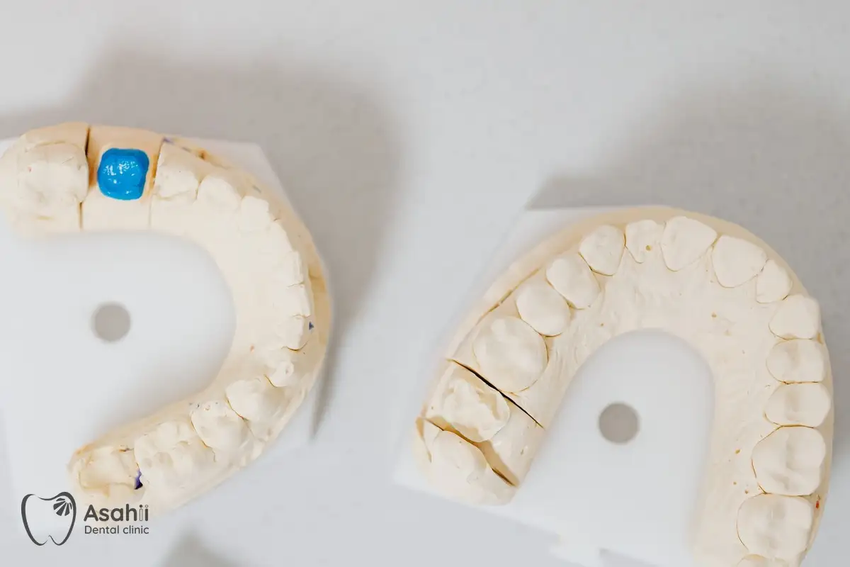 Mẫu hàm thạch cao lấy dấu răng: bước để phòng lab làm mão sứ vừa khít với răng đã mài