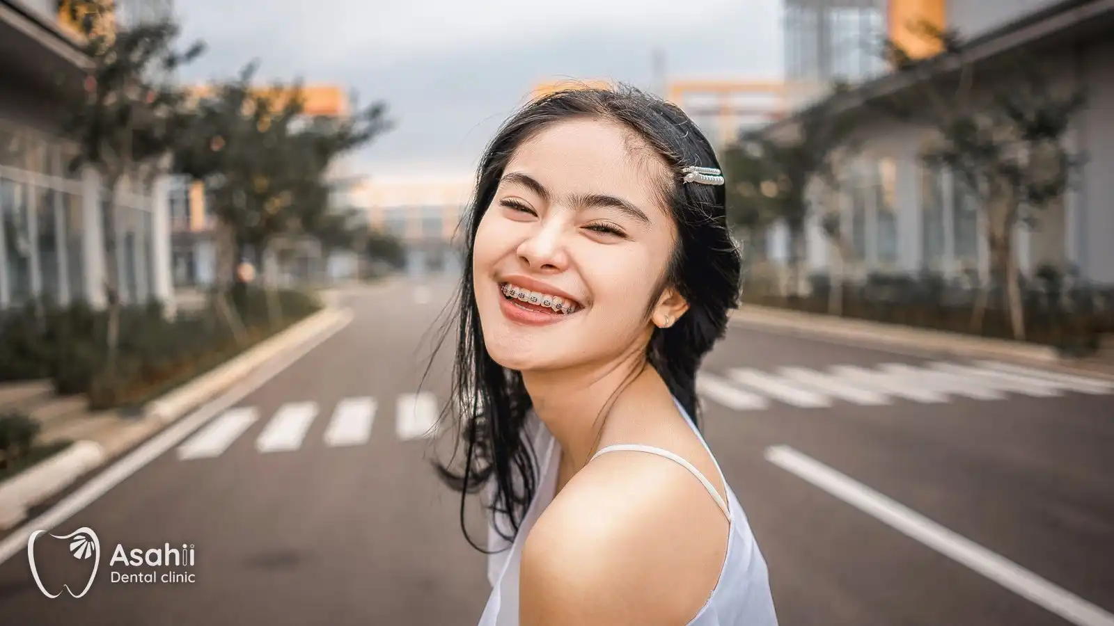 Nụ cười với mắc cài: mắc cài kim loại, mắc cài sứ hay khay trong suốt đều có ưu nhược điểm riêng