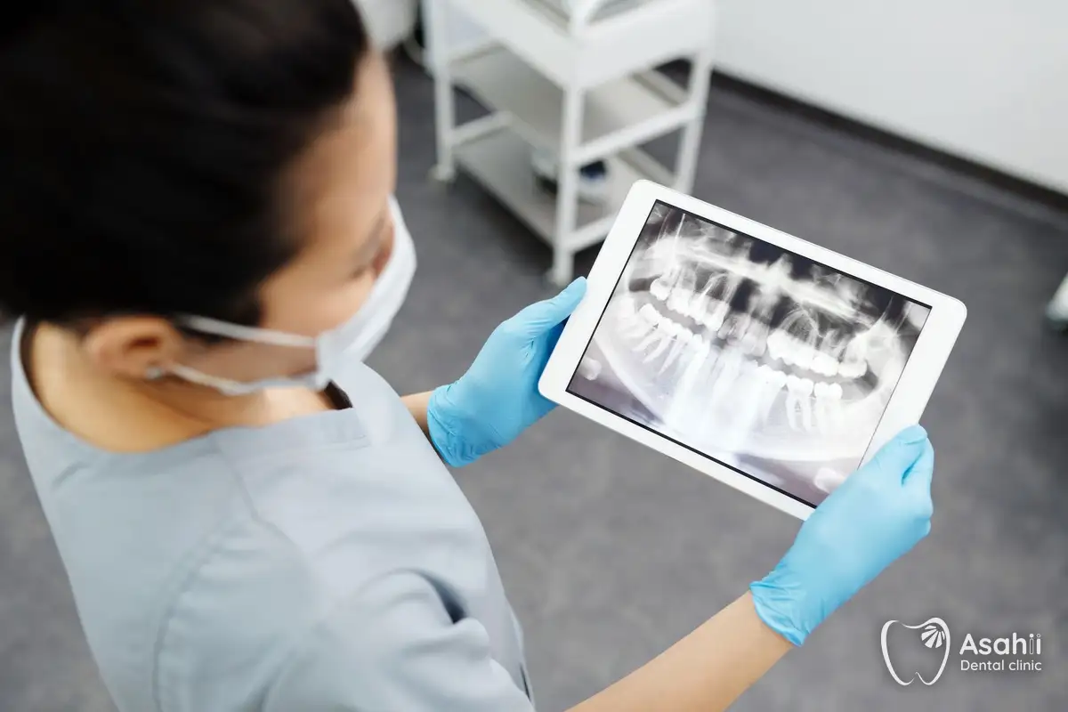 Phim X-quang toàn hàm cho thấy hướng mọc của răng khôn và vị trí dây thần kinh