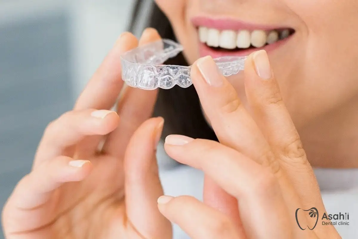 Khay niềng trong suốt: gần như vô hình, tháo ra khi ăn và chải răng, cần đeo đủ giờ mỗi ngày