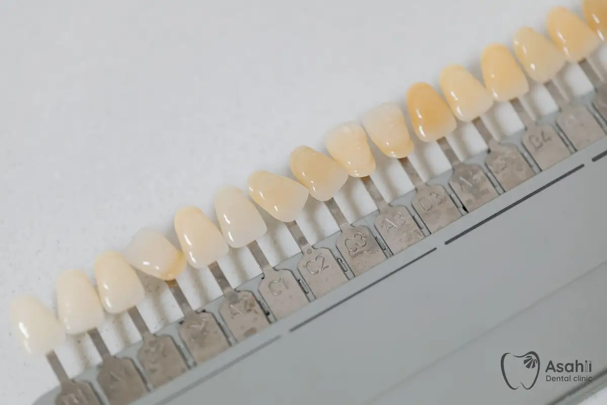 Bảng so màu chọn màu mão sứ: răng sau điều trị tuỷ thường cần bọc sứ để không bị vỡ