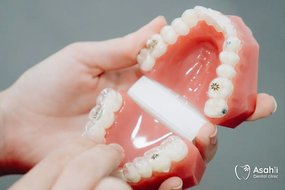 Biết cấu tạo mắc cài, dây cung và thun giúp cha mẹ mô tả đúng sự cố khi gọi phòng khám