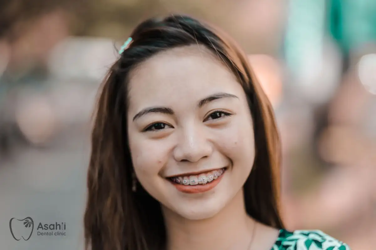 Mắc cài kim loại: bền, chi phí hợp lý và xử lý tốt nhiều ca lệch lạc răng phức tạp