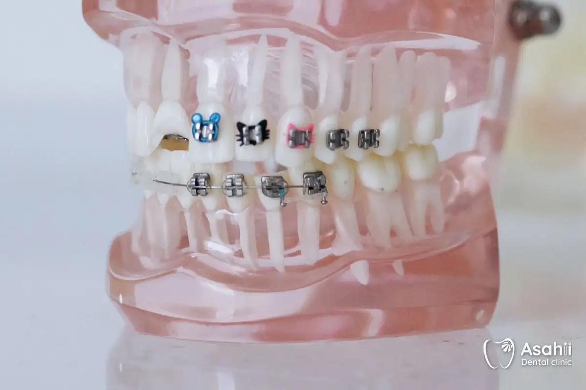 Sau khi răng đã vào đúng vị trí, minivis được tháo ra; giữ sạch quanh vít mỗi ngày là việc quan trọng nhất