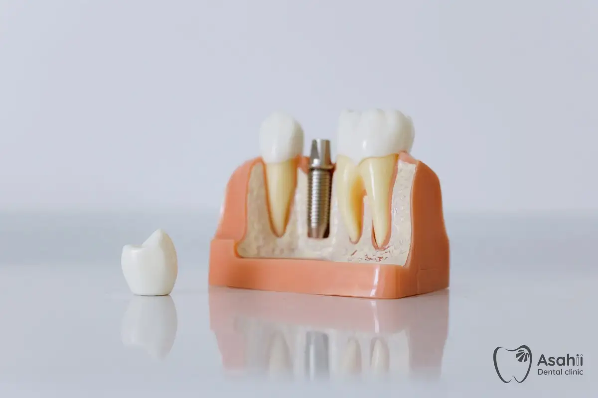 Mô hình trụ implant và mão răng: một trong các lựa chọn phục hồi răng đã mất